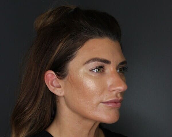 Patient result — oblique view before treatment